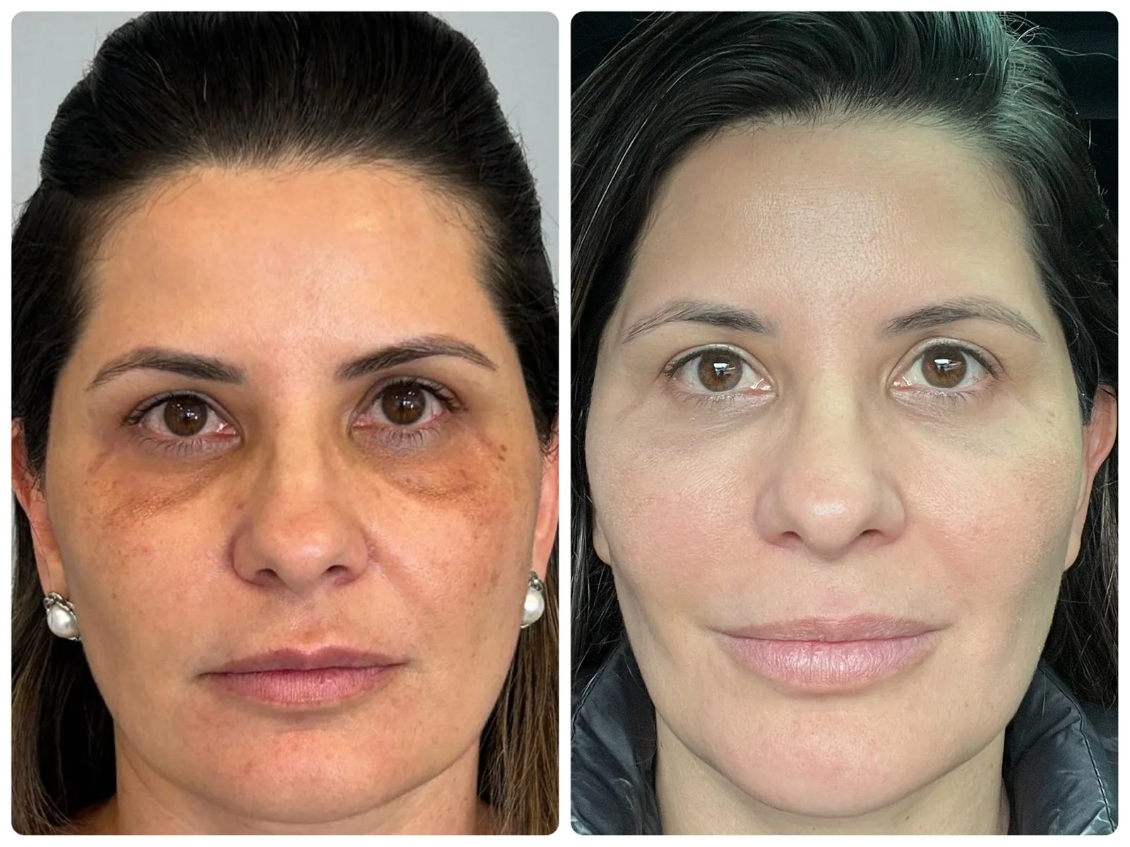 Antes e depois da pele da Dra. Aline Mendes após o protocolo de 30 dias
